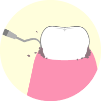 歯石を除去する